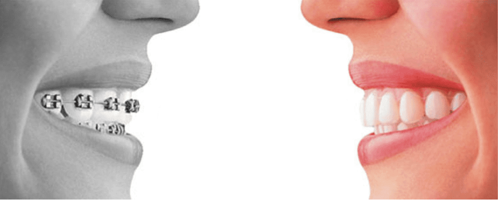 invisalign3 invisalign3