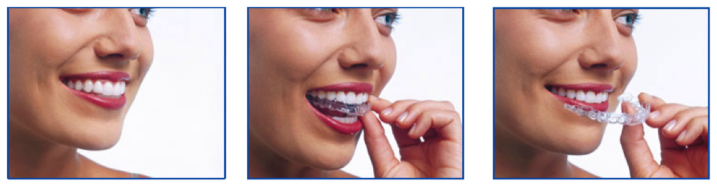 invisalign3-immagini invisalign3-immagini